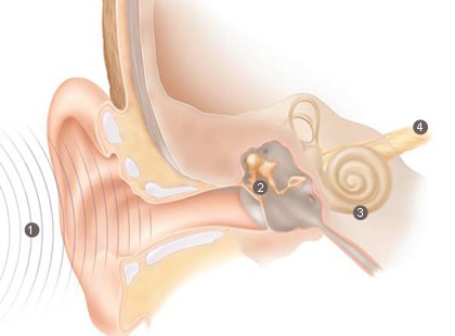 cochlea/ implant